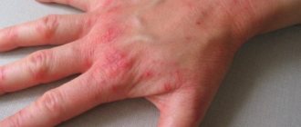 Neurodermatitis