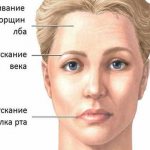 Неврит лицевого нерва (паралич Белла)