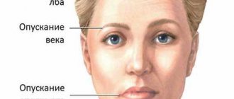 Facial neuritis (Bell's palsy)