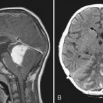 Опухоль головного мозга мозжечка последствия