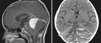 Cerebellar brain tumor consequences