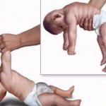 Основные симптомы спастической диплегии