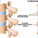 Остеохондроз