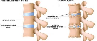 Osteochondrosis