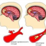 cerebral edema causes consequences