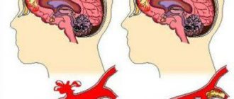cerebral edema causes consequences