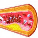 Deposits in blood vessels