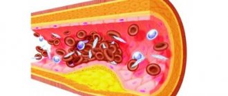 Deposits in blood vessels