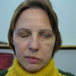 Facial nerve paresis