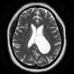 Cavity of the septum pellucidum on MRI of the brain