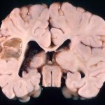 Porencephaly of the brain