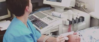 Появление субэпендимальной кисты головного мозга у новорожденных