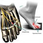 Причина невралгии Мортона
