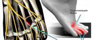 Cause of Morton's neuralgia