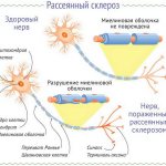 рассеянный склероз