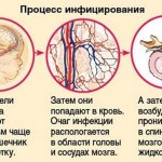 Development of meningitis