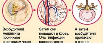 Development of meningitis