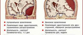 Сдавление головного мозга