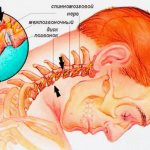 Cervical migraine