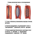 Схема ангиопластики