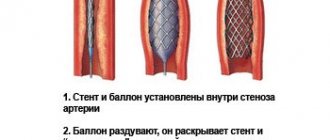 Схема ангиопластики