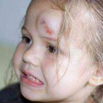 шишка на голове от удара лечение у ребенка