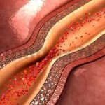 Шум пульсации появляется при спазме или стенозе артерий