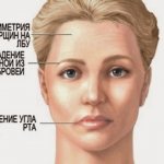 Симптомы инсульта