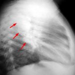 Symptoms of acute disseminated encephalomyelitis