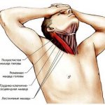 синдром лестничной мышцы и его классификация