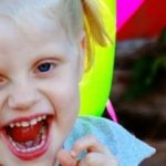 Parsley syndrome - “happy doll” syndrome