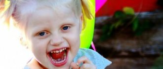 Parsley syndrome - “happy doll” syndrome