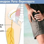 Синдром Рота