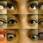 tholos hunt syndrome