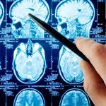 Brain imaging for neurological disorders