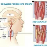 Cerebral vascular spasm: symptoms and treatment