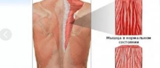 Спазм в мышце