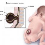 спинномозговая грыжа виды
