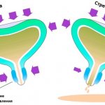 Stress urinary incontinence