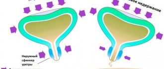 Stress urinary incontinence