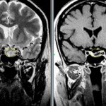 Трансназальное удаление аденомы гипофиза