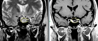 Transnasal removal of pituitary adenoma