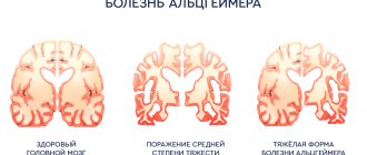 type of alzheimer's disease