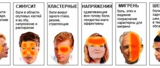 Виды цефалгии