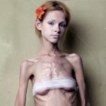 виды нервной анорексии