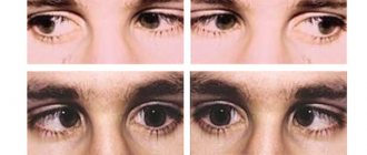 types of nystagmus