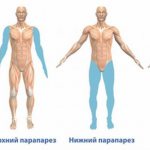 Types of paraparesis