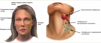 Inflammation of the nerve ganglion