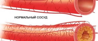Зачем нужна чистка сосудов головного мозга
