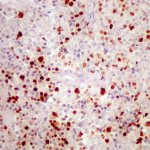 Malignant degeneration of ependymal cells